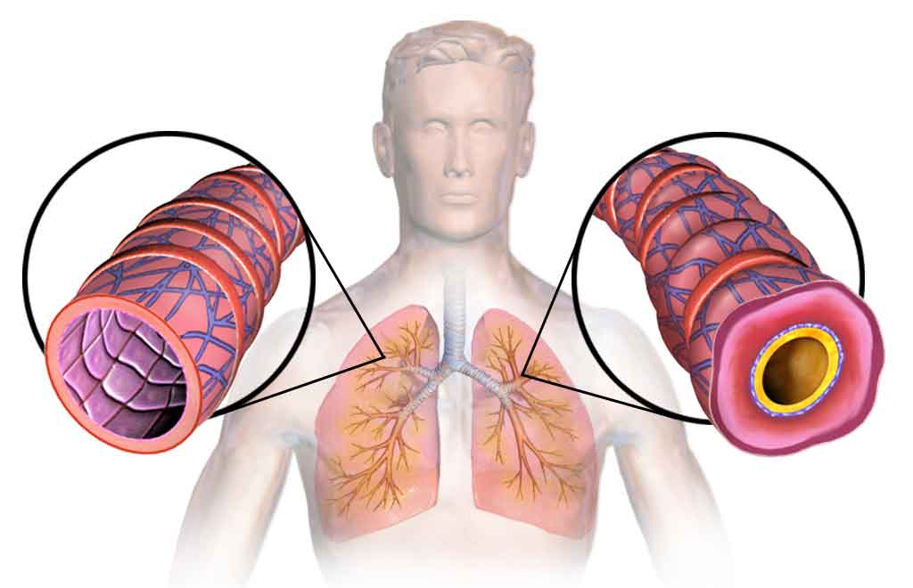 What Causes Asthma